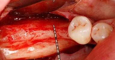 Výzkumník z Maďarska představí unikátní techniku augmentace kosti „sausage technique“