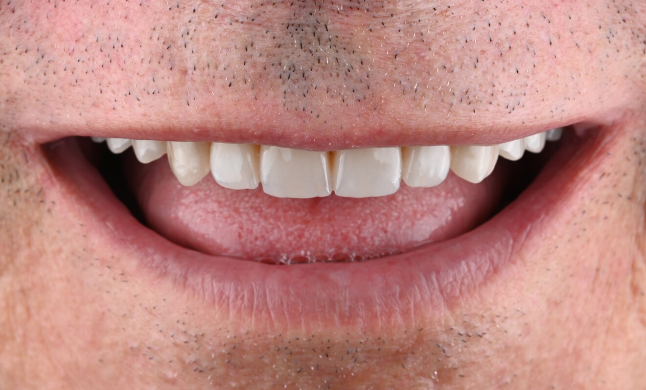 Fig. 12 : Résultat du traitement, vue extraorale.