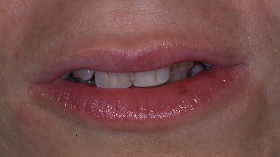 Figg. 1, 2 - Labbra incompetenti, si evidenziano i pigmenti nel sestante anteriore superiore.