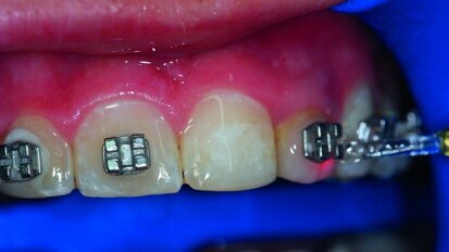 Le laser Er:YAG dans les phases de collage et de dépose des brackets lors du traitement orthodontique