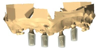 Kompleksowe postępowanie w leczeniu implantologicznym szczęki z zastosowaniem CBCT i CAD/CAM