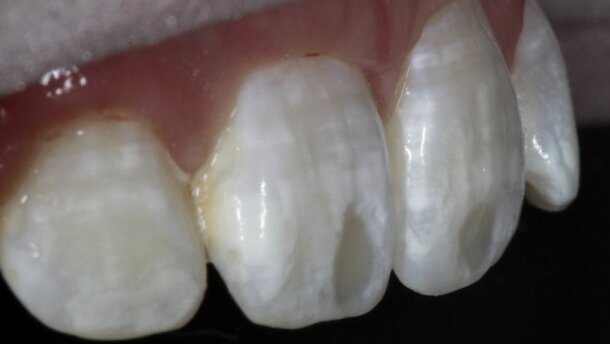 Leczenie białych plam na powierzchniach wargowych zębów – opis przypadku