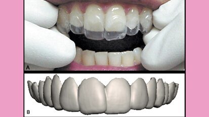 Estética y blanqueamiento dental en la era digital (Capítulo 4)