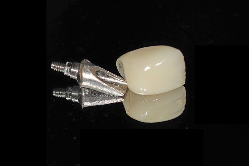 Fig. 26a: The prefabricated CAD/CAM abutment and transitional crown