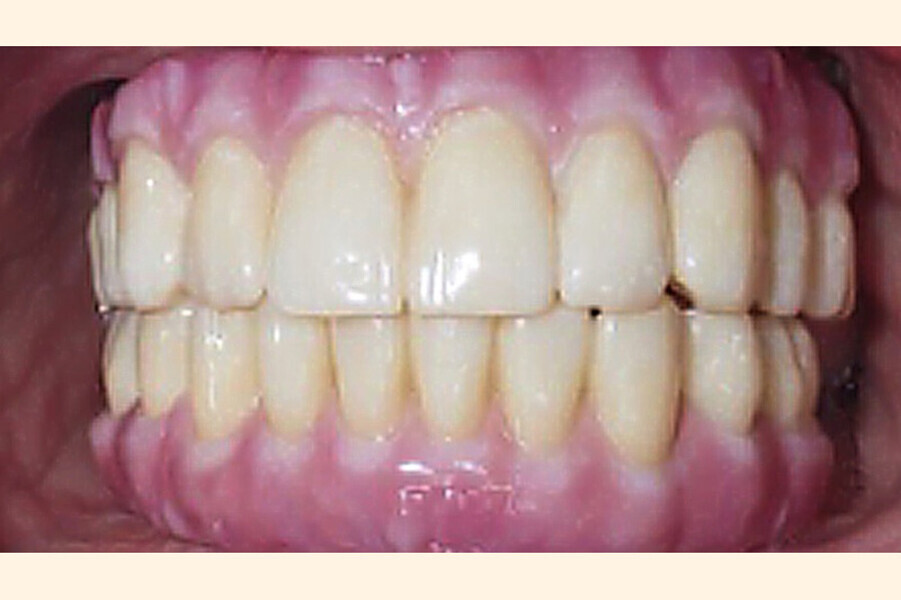 Fig. 28. Rx Pre-operatoria, Prótesis híbrida inmediata con 5 años de evolucion y Rx Control a los 5 años.