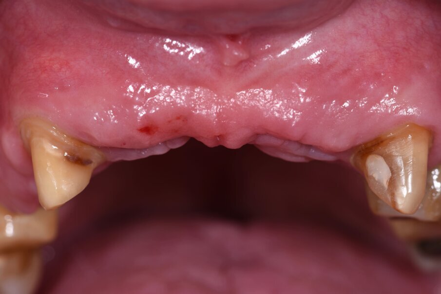 Fig. 18_Nella preparazione si devono rispettare i parametri di parallelismo, rispetto biologico del solco e arrotondamento degli spigoli per ottimizzare anche la stabilizzazione della dima chirurgica.