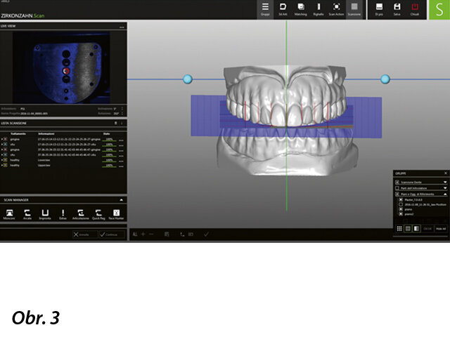 Nastavení individuálních parametrů konkrétního pacienta v programu Zirkonzahn.Archiv. V něm uložené údaje se importují do programu Zirkonzahn.Scan a dojde k fúzi dat.