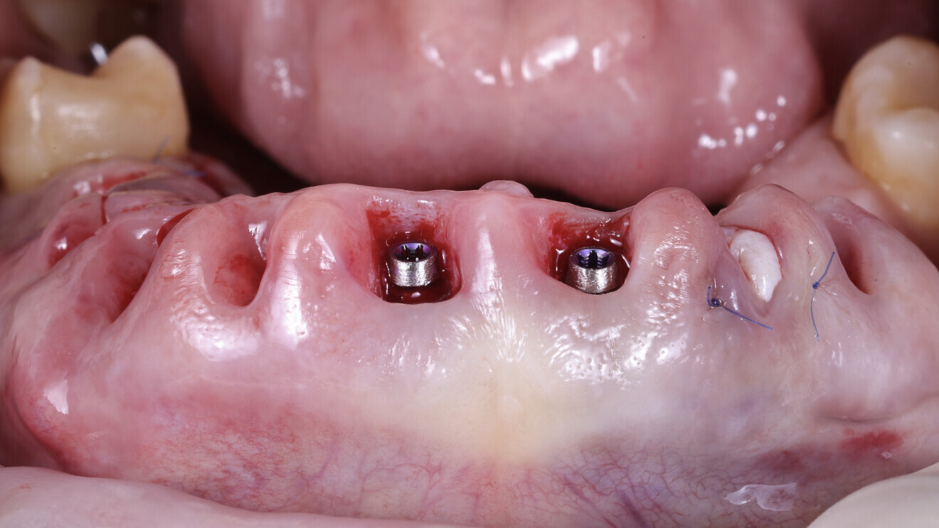 Fig. 21: Sutured area after grafting.