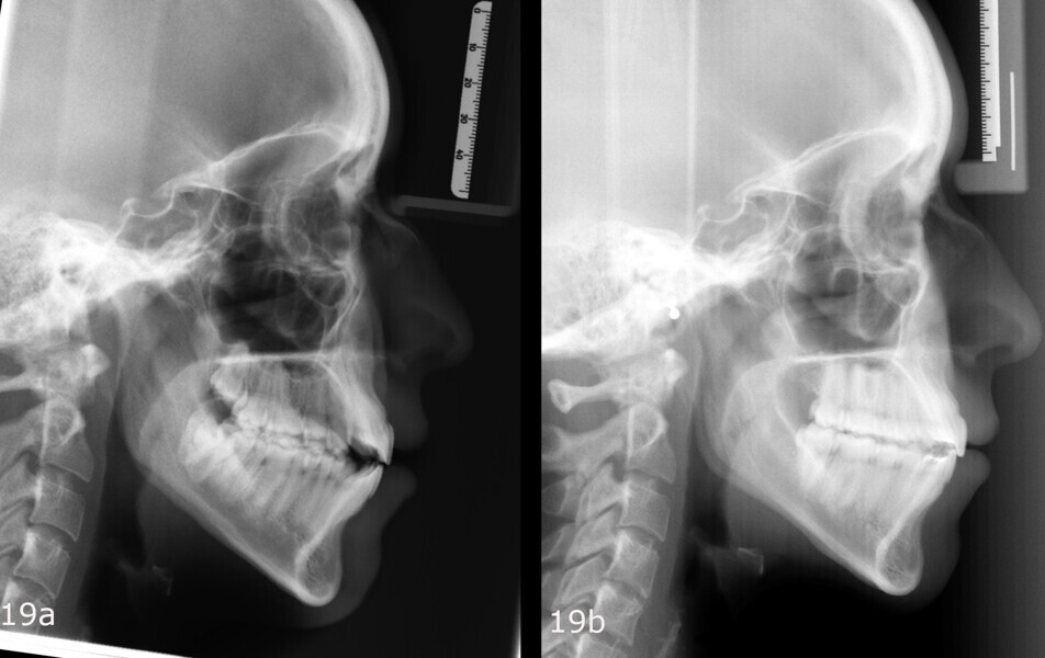Figs. 19a & b: Comparison between the (a) initial and (b) final lateral radiographs. Anticlockwise mandibular rotation had been achieved to preserve the periodontium of the mandibular anterior teeth and improve the facial profile and lip closure.