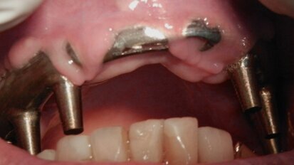 Regeneración Tisular Guiada con Barreras Oclusivas confeccionadas por CAD-CAM