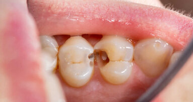 O estudo oferece novas visões sobre a doença periodontal e a resposta protetora do corpo