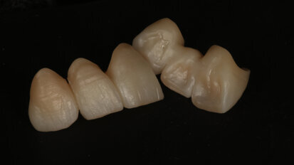 Fig. 10: Appearance of the restorations immediately after sintering.