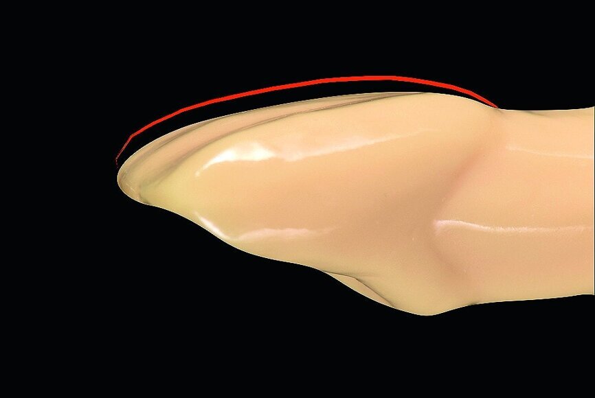 Fig. 3: Ideal gradual thinning no preparation veneer