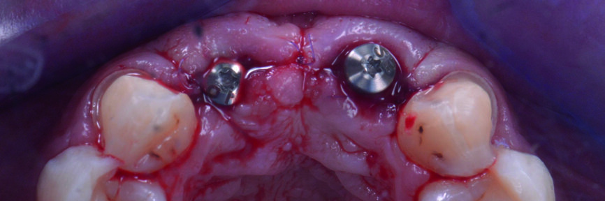 Fig. 18 : Après mise en place des vis de cicatrisation. 