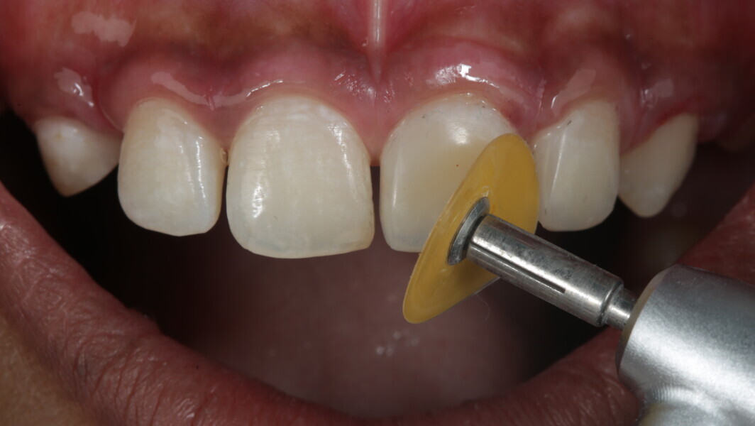 Fig 35: Sof-Lex finishing super fine disc was used for final finish and shine at high speed with irrigation.