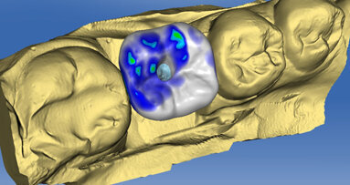 Posizionamento implantare guidato con corona CAD/CAM CEREC