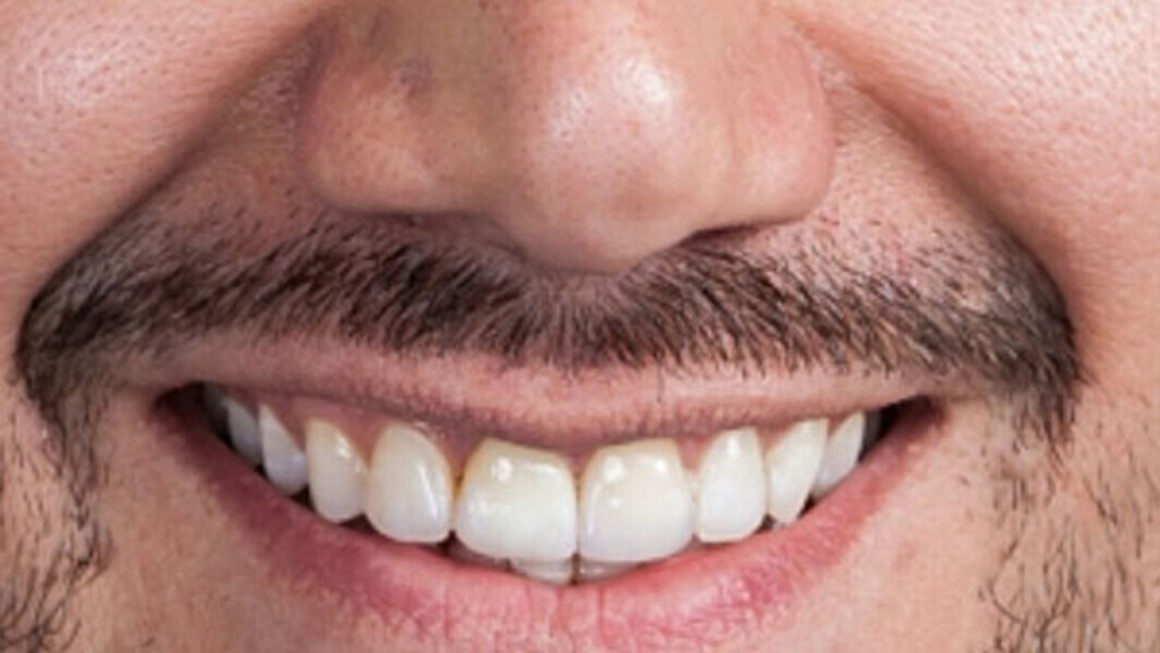 Fig. 15. Resultado: el paciente se mostró muy satisfecho en el control de seguimiento al cabo de unas semanas.