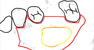 Kontrowersje wokół zabiegu podniesienia dna zatoki szczękowej od strony podniebiennej
