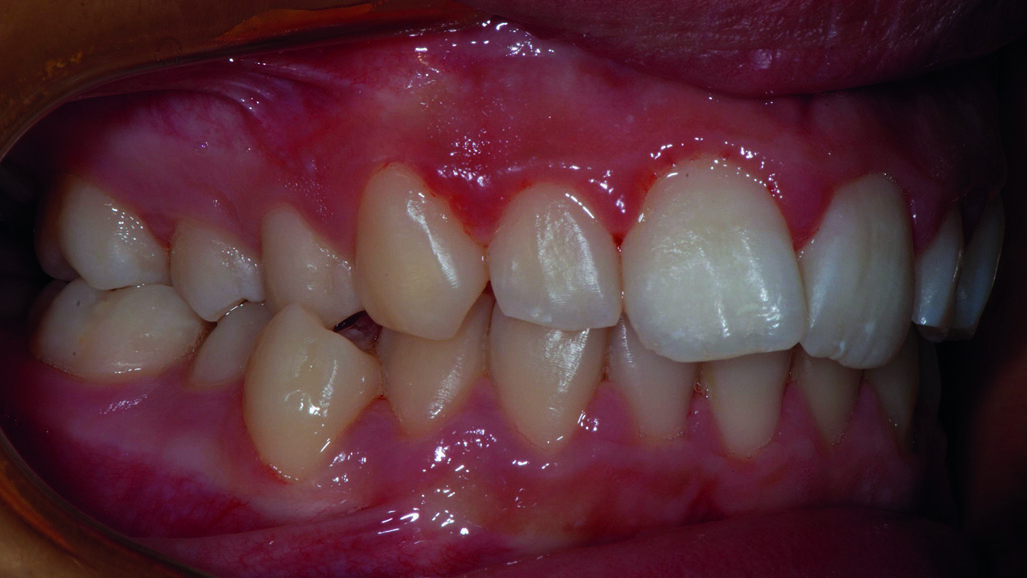 Cross-bite monolaterale e mandibular-shift. Trattamento con espansore palatino al nickel-titanio