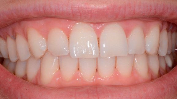 Approccio terapeutico combinato sbiancamento e Infiltrazione Icon della White Spot Lesions (WSL)