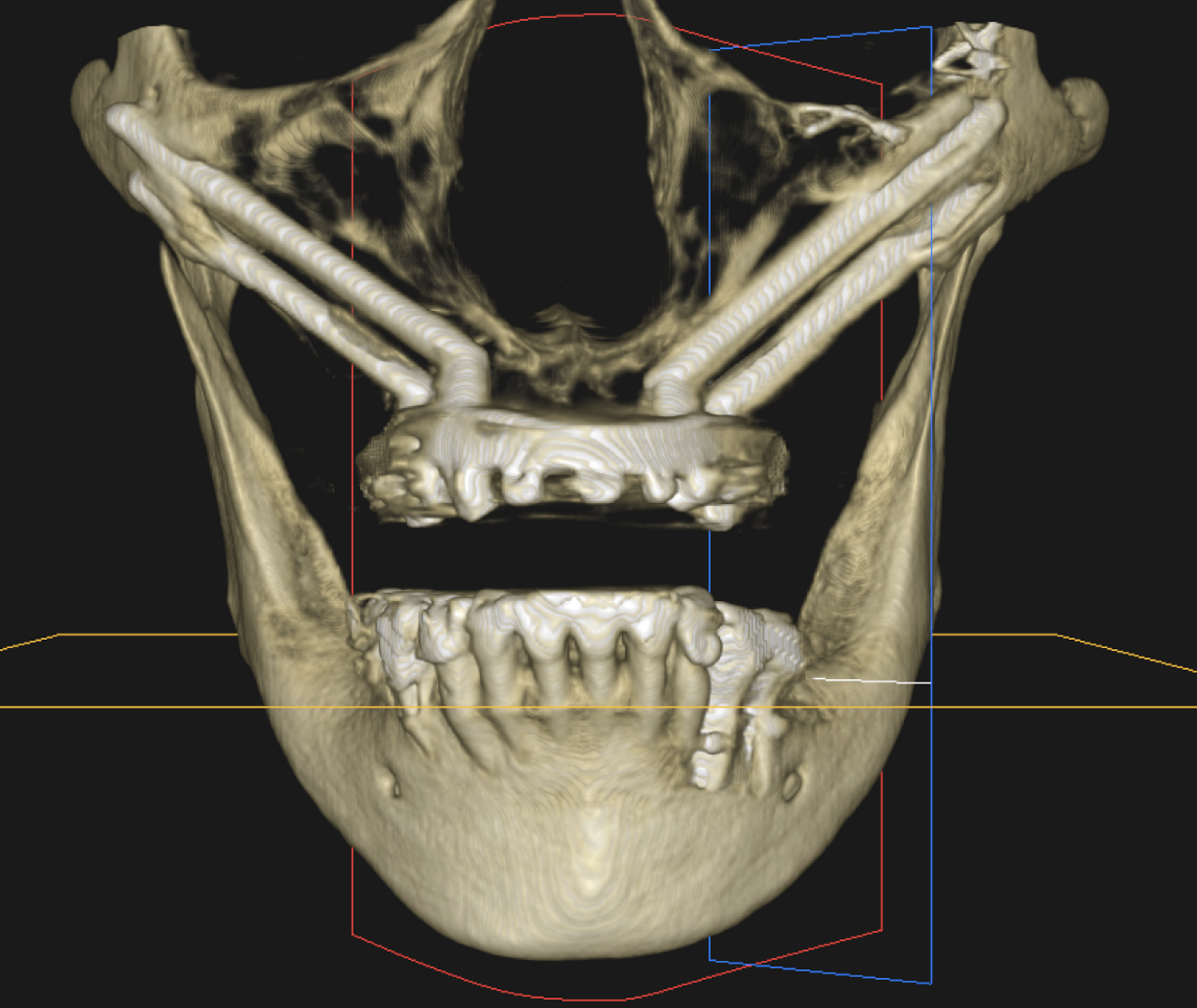 Fig. 1b : Configuration en « quad-zygo » sur CBCT.