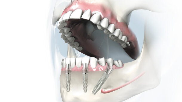 9. Unnaer Implantologietage