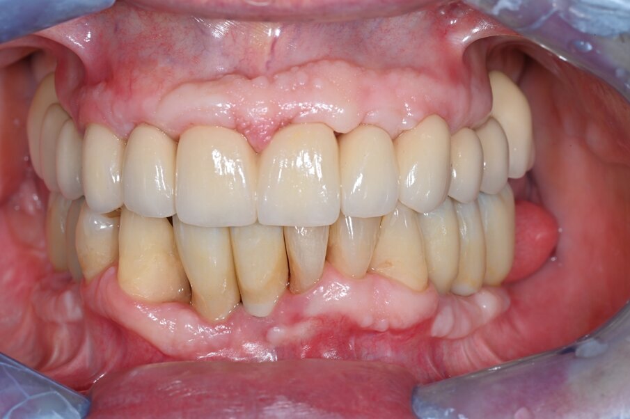 Fig. 6_Follow up a 4 anni: visione frontale della riabilitazione definitiva a 4 anni.