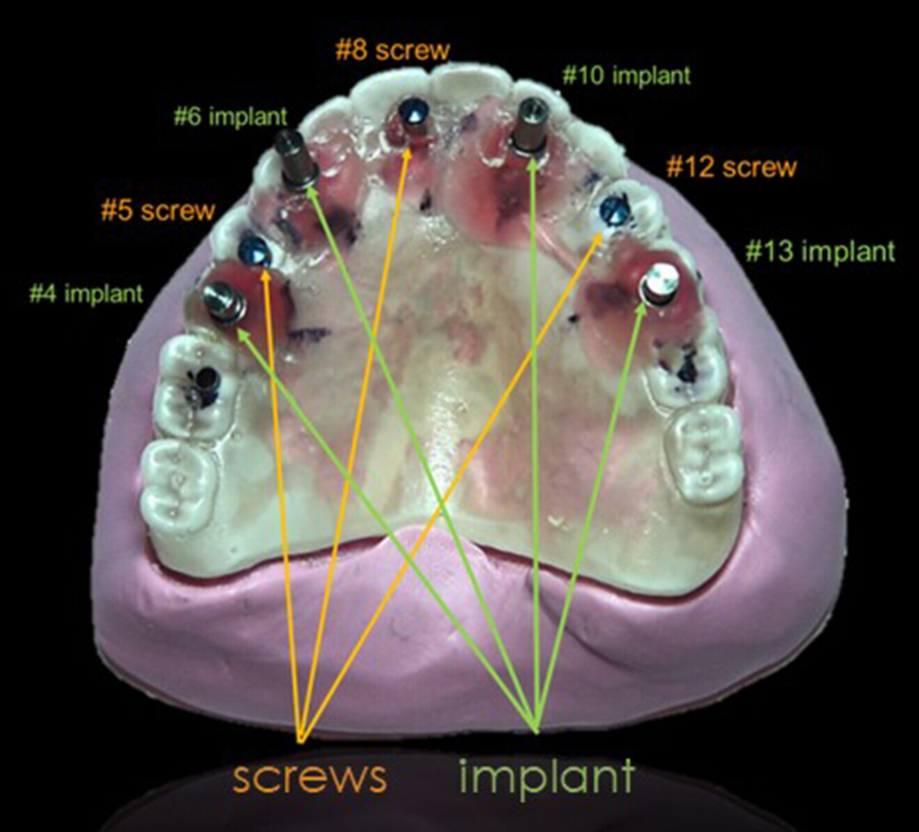 Fig. 16: Final surgical guide on the putty base after the holes for the guide posts on the duplicate denture had been enlarged to allow seating over the guide posts and sleeves and the guided sleeves had been fixated in place. Orange indicates positioning of implants in the sites of the maxillary right second premolar, right canine, left lateral incisor and left second premolar. Green indicates positioning of fixation screws in the sites of the maxillary right first premolar, right central incisor and left first premolar.