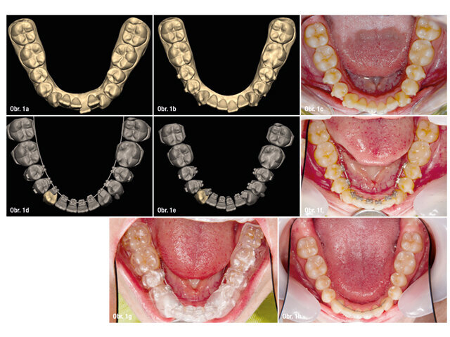 Obr. 1a: Počáteční poloha zubů před úpravou alignery  Obr. 1b: Situace před umístěním pomocného aparátu pro derotaci špičáků a urychlení terapie  Obr. 1c–h: Další fáze léčby až do konečného výsledku