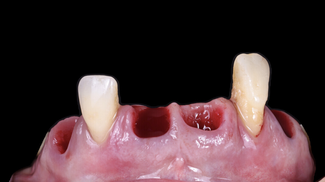 Fig. 15: Teeth retained to support the surgical guide.