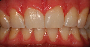 Valutazione dell’efficacia  dello sbiancamento professionale domiciliare con il nuovo Ena White 2.0: risultati a sei mesi allo spettrofotometro