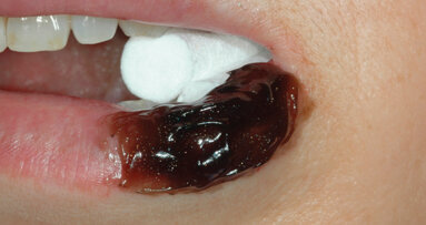 Stress ossidativo e gel gengivale NBF