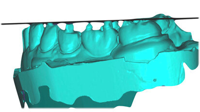 Digitální postupy pro plánování okluze se sekvenčním vedením u složitých klinických případů