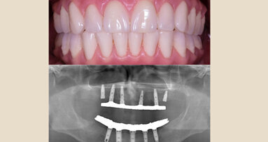 Prótesis Híbrida Inmediata en pacientes edéntulos mandibulares