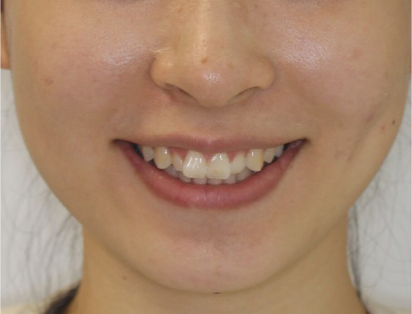 Fig. 1a: Pretreatment situation. Frontal smiling view.  