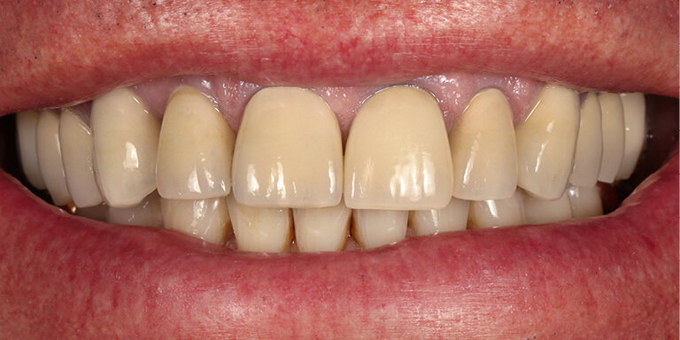 Fig. 22: A patient wearing 10-year-old veneered zirconia crowns wants her esthetic appearance to be improved. The crowns appear rather dark and grey. The proportions look unflattering.