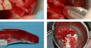Protezione della membrana sinusale nell’esecuzione del rialzo di seno con innesti ossei eterologhi