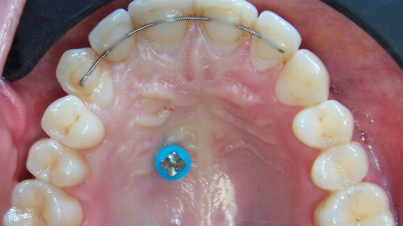 Composito Flow, filo intrecciato e microvite: quale novità?