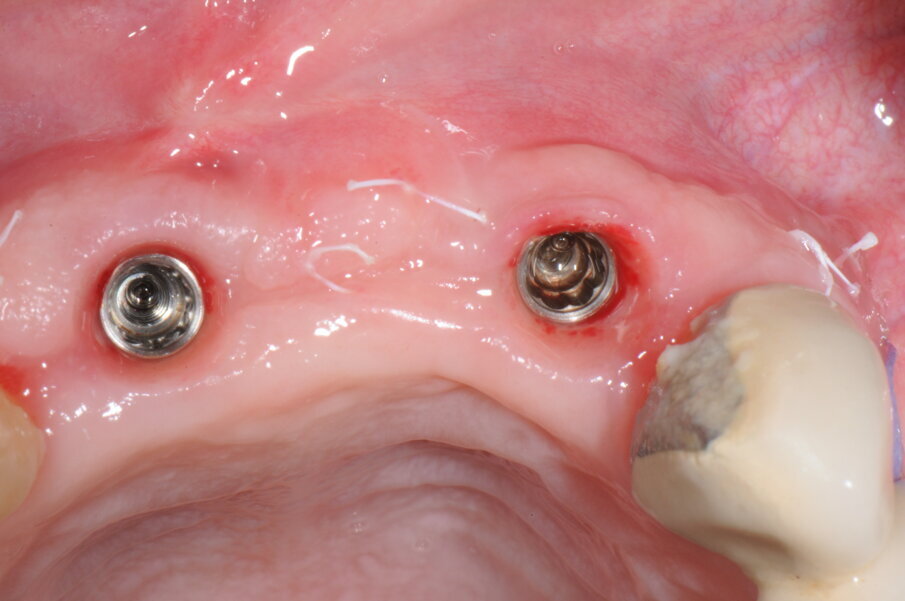 Fig. 22a, 22b - Valutazione dei tessuti duri e molli perimplantari.