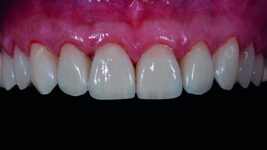 Fig. 16f : Résultat final immédiatement après le retrait de la digue en caoutchouc.