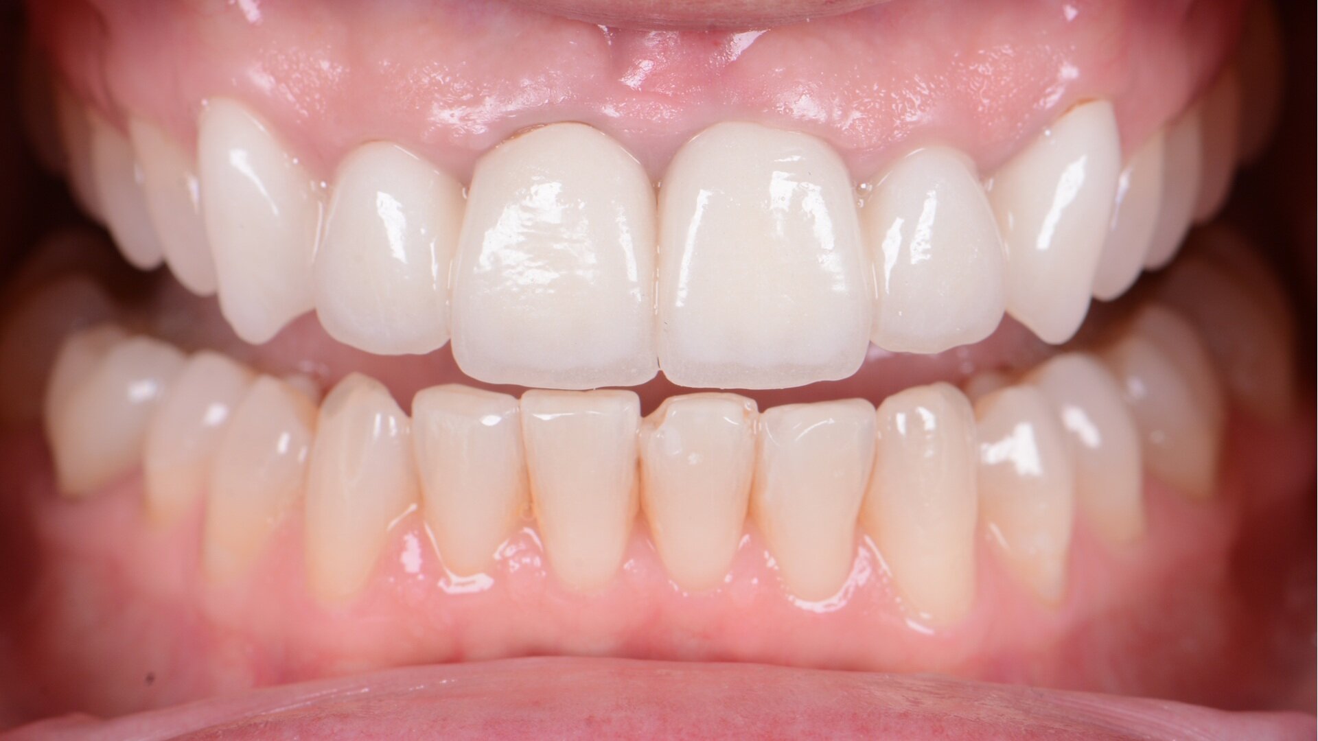 A bright new smile with KATANA Zirconia YML