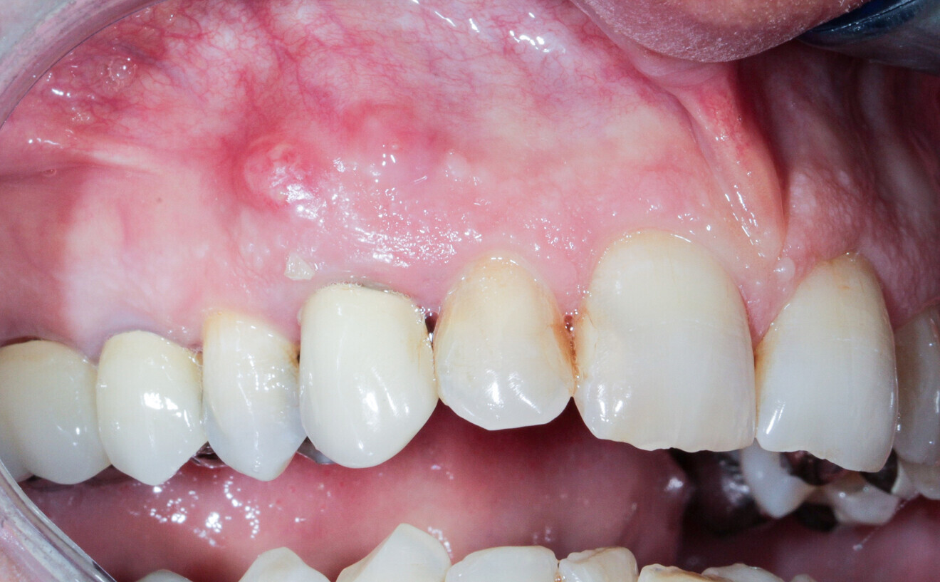 15: Radicular fracture at tooth #13 under a crown and with a fistula opposite.