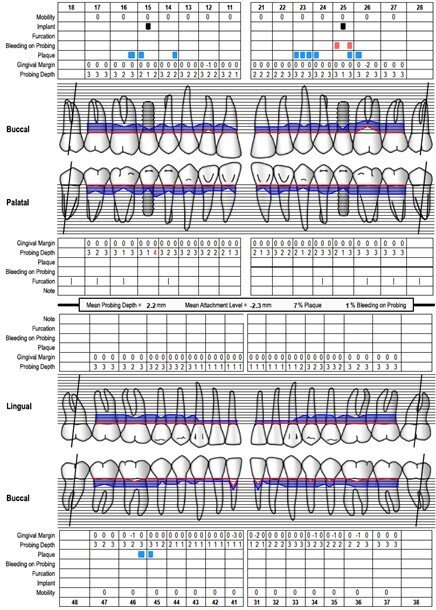 Fig. 6 - Charting parodontale a 1 anno.