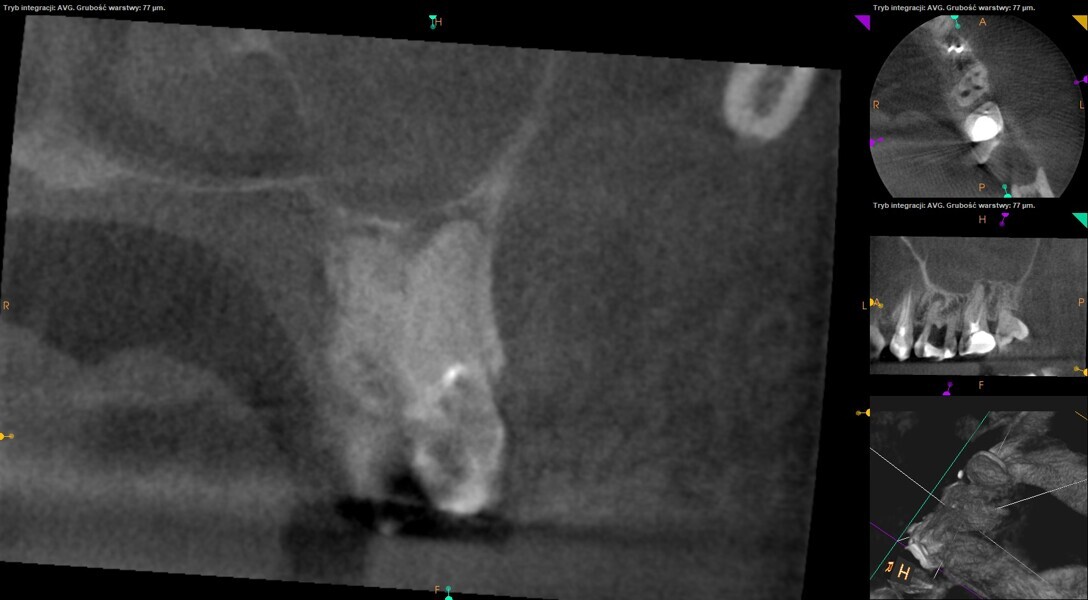 Fig. 9: Pre-op CBCT image showing a radiolucency above the MB root of the maxillary second molar. The radiolucency could be seen more clearly near the expected apical foramen of the MB2 canal.
