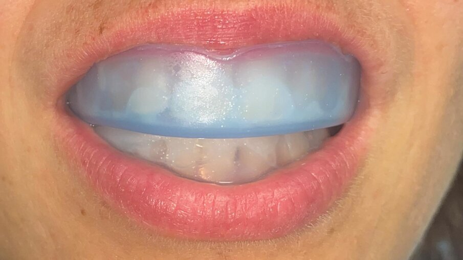 Fig. 12 - Tray in situ per 3 minuti con il siero attivato.