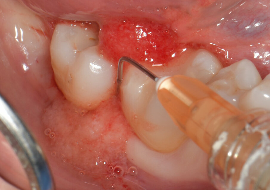 Fig. 2 - H42 viene applicato partendo dal fondo della tasca fino a colmarla completamente.