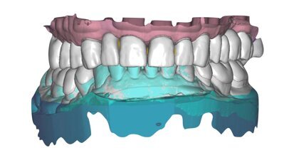 Procedure digitali per il design di una occlusione sequenziale in un caso clinico complesso
