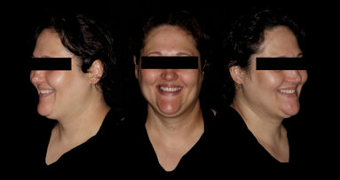 One-year follow-up of Straumann Fast Molar solution in bilateral maxillary premolars