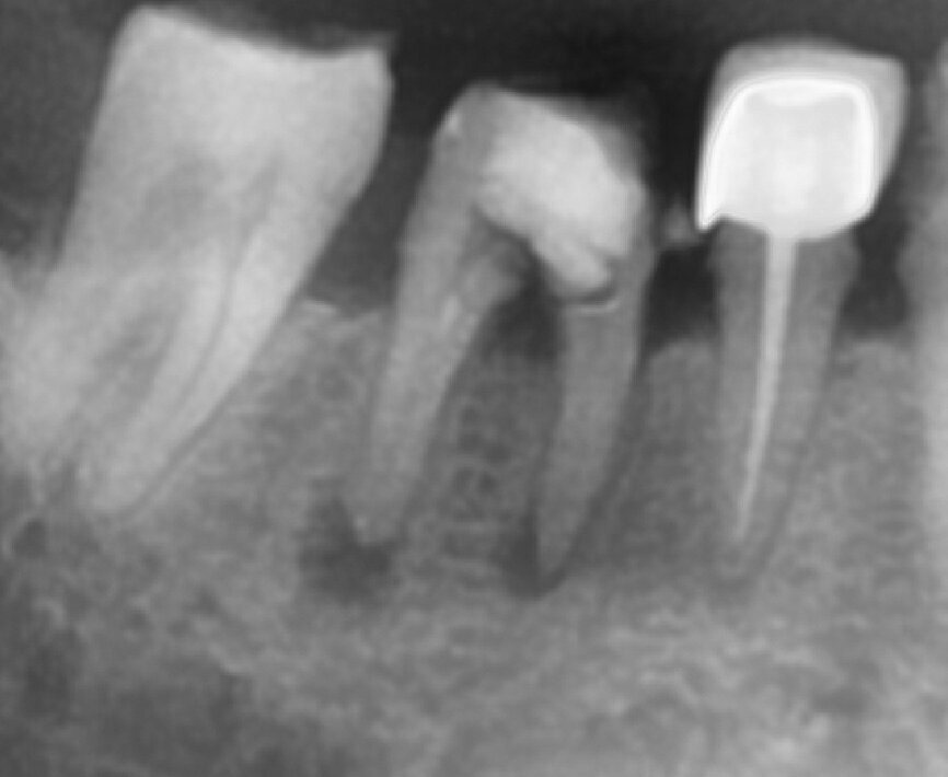 Fig.1b: Pre-op radiograph taken by the author in relation to tooth #46 (January 2019).