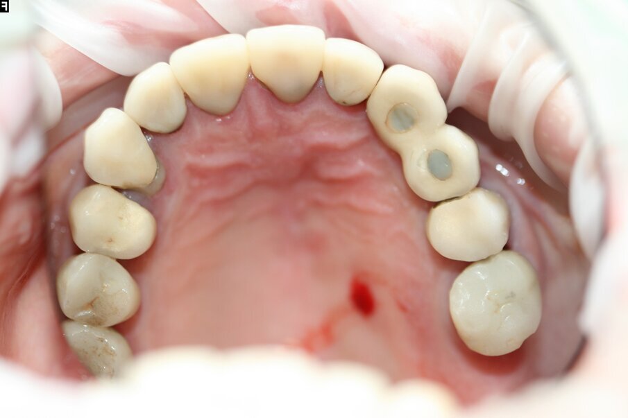 Fig. 3: Maxillary arch before treatment.